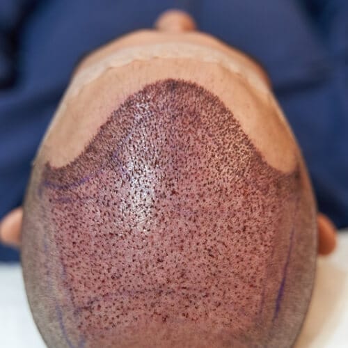 Cuidado del cabello post-injerto- pautas y consejos para una recuperación exitosa por Clínica Fortuny, clínica capilar en Tenerife