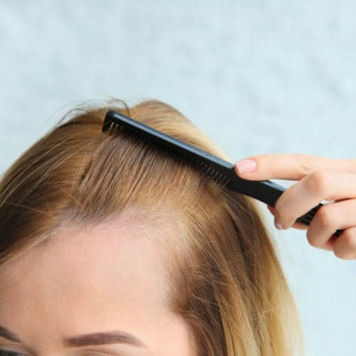 Qué es la alopecia androgénica en mujeres por Clínica Fortuny en la isla de Tenerife