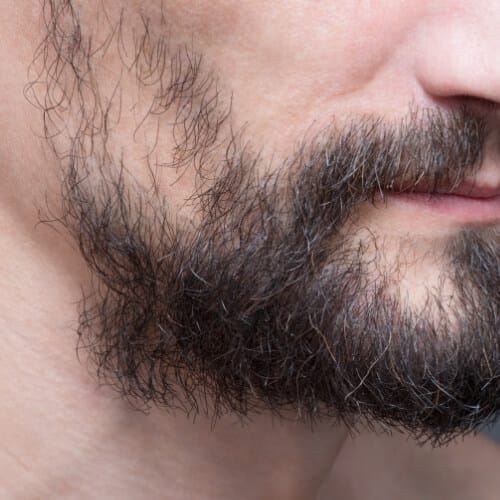 Descubre cómo obtener una barba poblada gracias al injerto capilar de Clínica Fortuny en la ciudad de Tenerife
