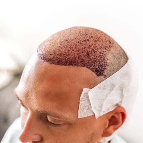 cuando empieza a salir el pelo injertado