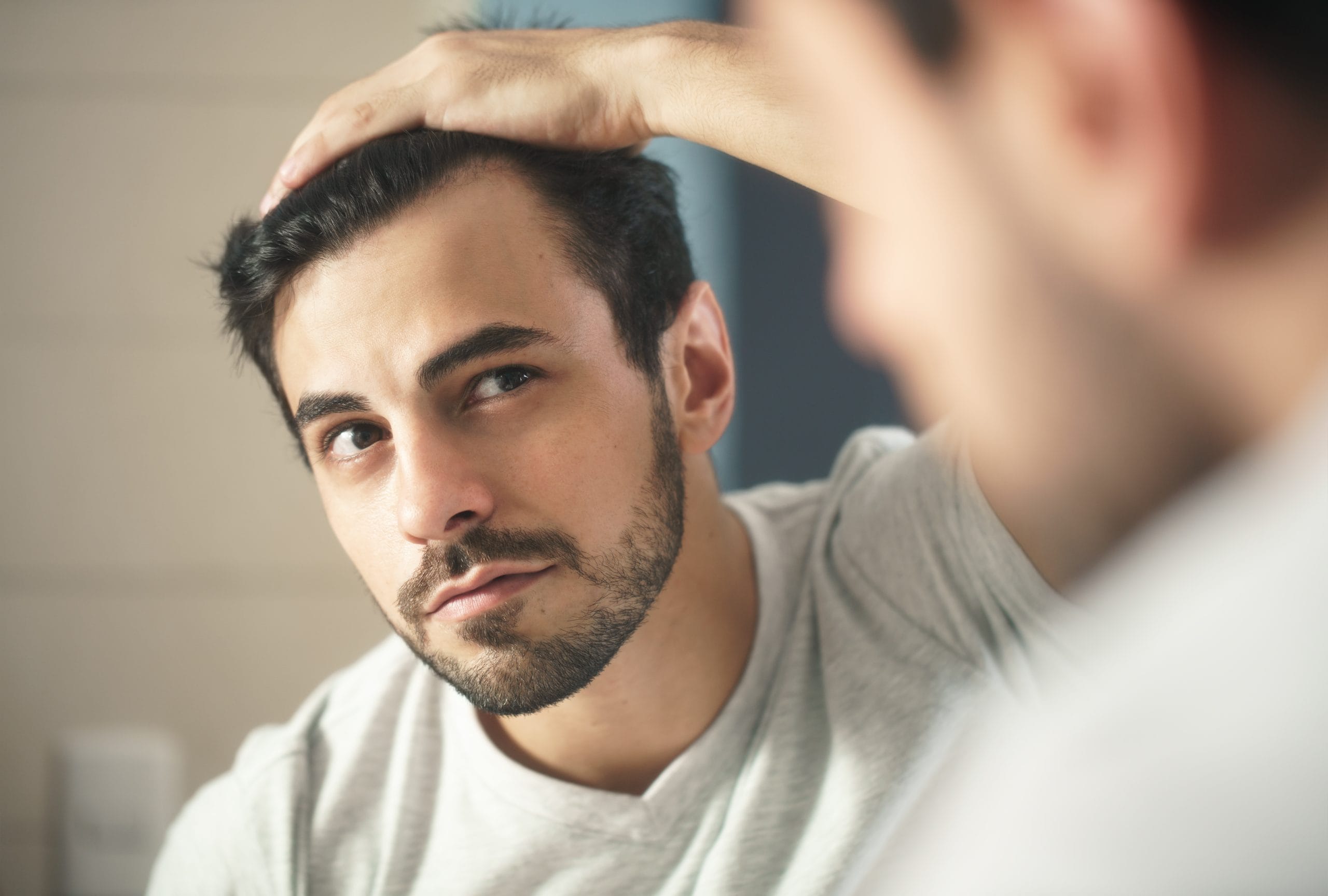 Cómo tratar la alopecia androgénica