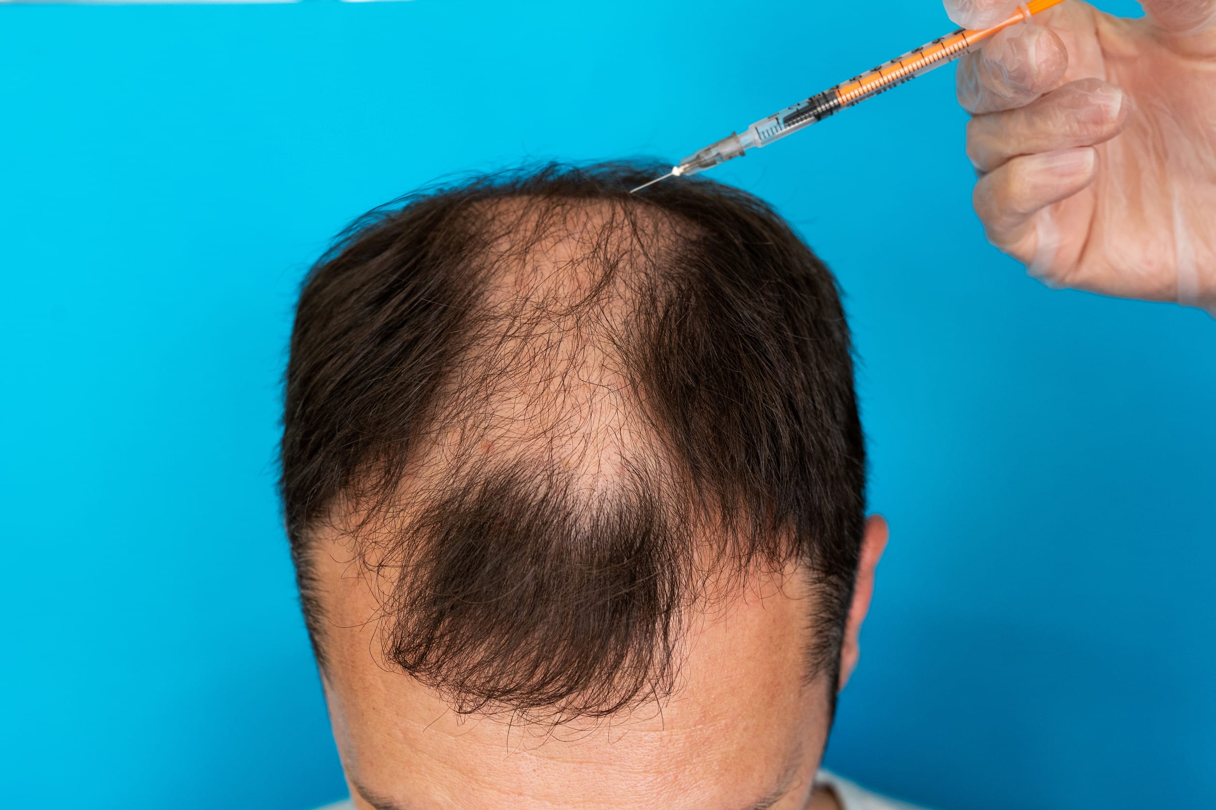 Trasplante capilar sin medicaci&oacute;n