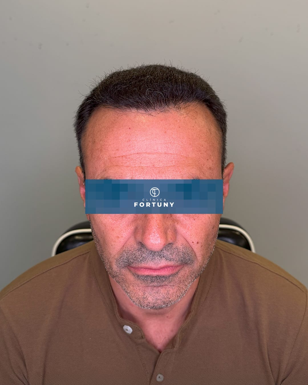 PACIENTE IMPLANTE CAPILAR ANTES Y DESPUES