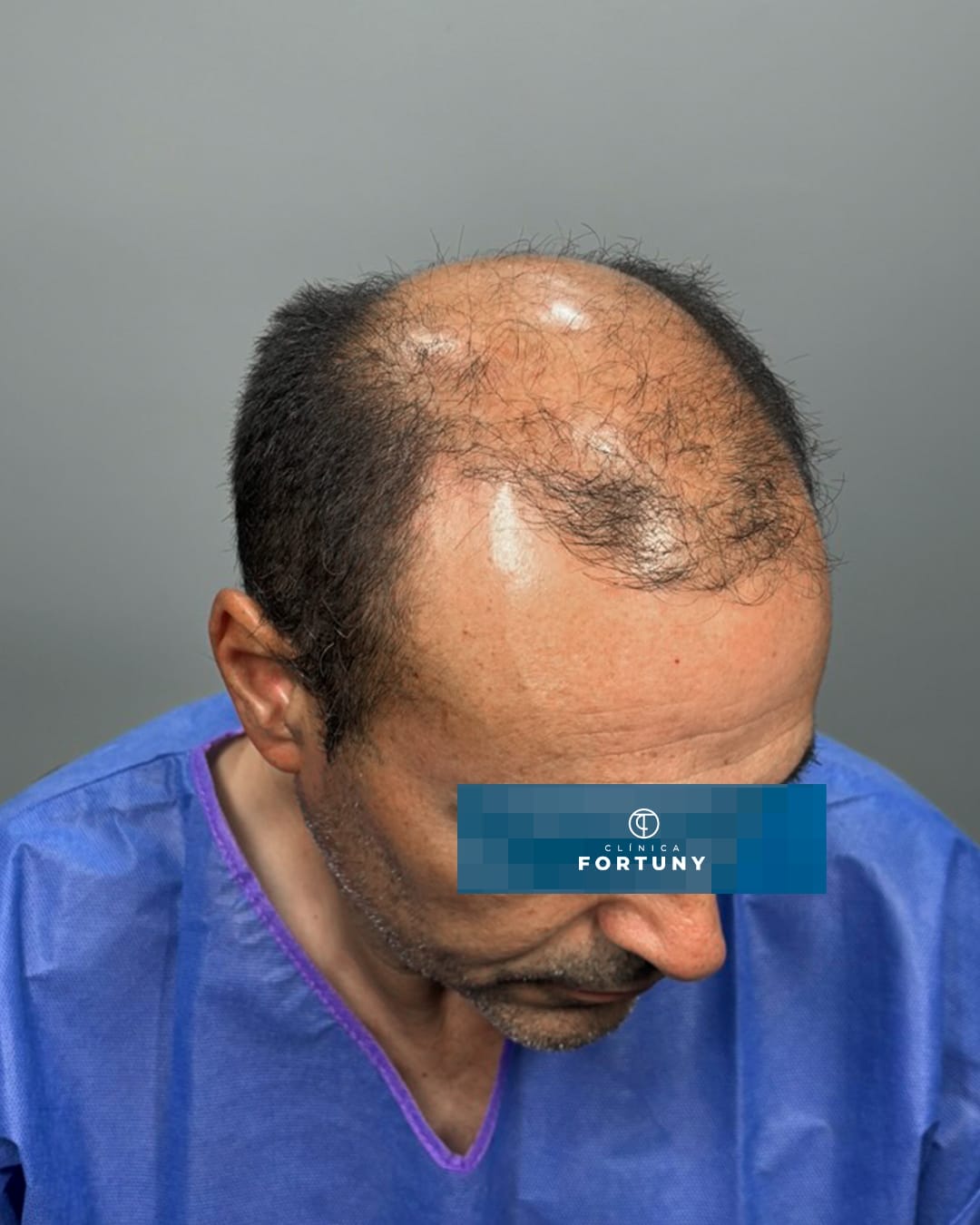 PACIENTE IMPLANTE CAPILAR ANTES Y DESPUES