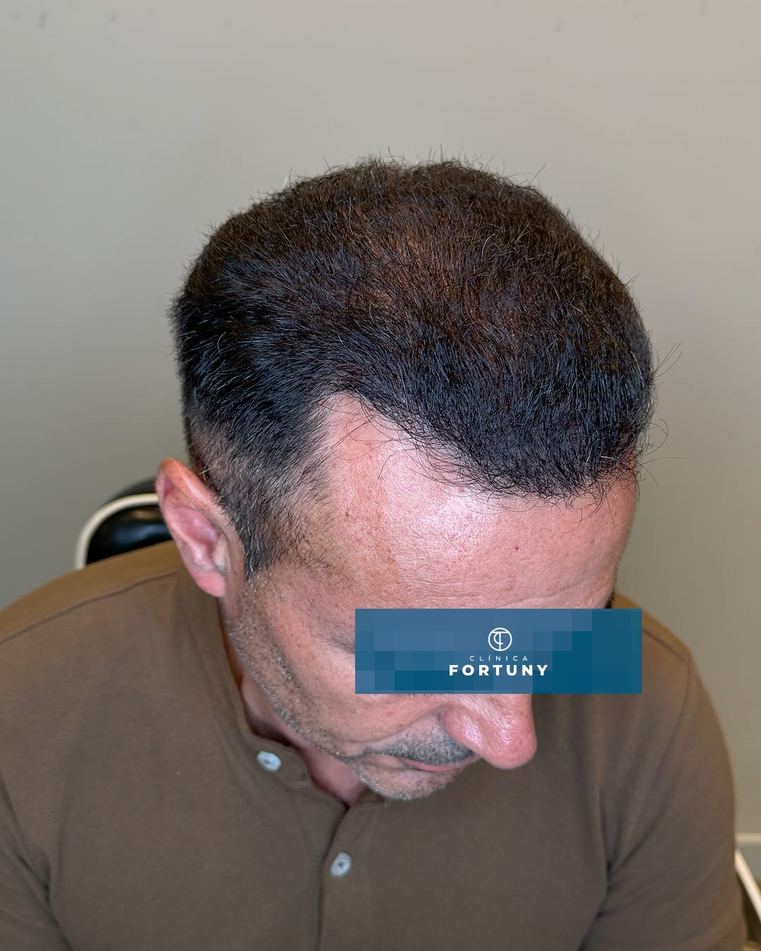 PACIENTE IMPLANTE CAPILAR ANTES Y DESPUES