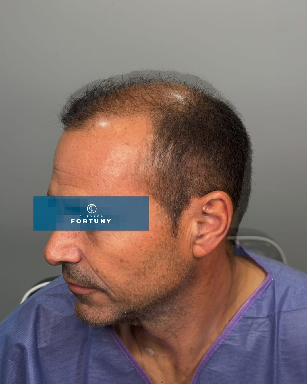 PACIENTE IMPLANTE CAPILAR ANTES Y DESPUES