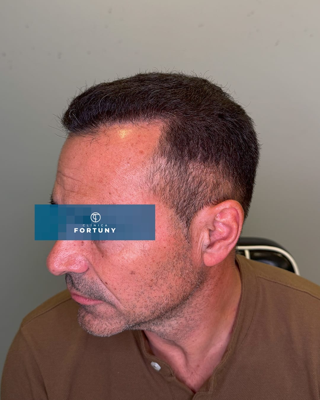 PACIENTE IMPLANTE CAPILAR ANTES Y DESPUES