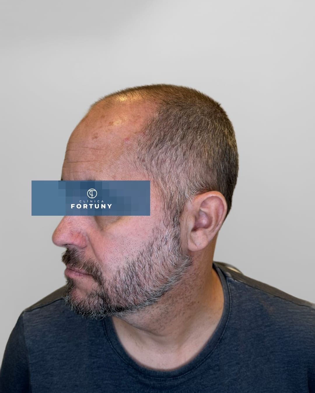 Paciente con alopecia con tratamiento de injerto capilar