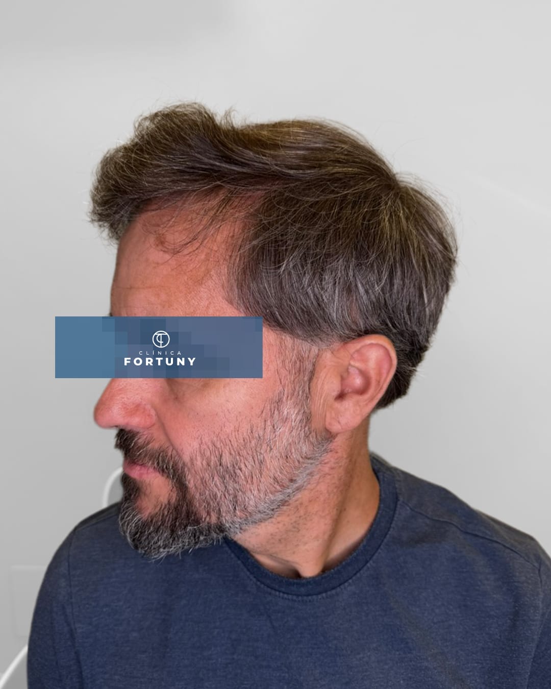 Paciente con alopecia con tratamiento de injerto capilar