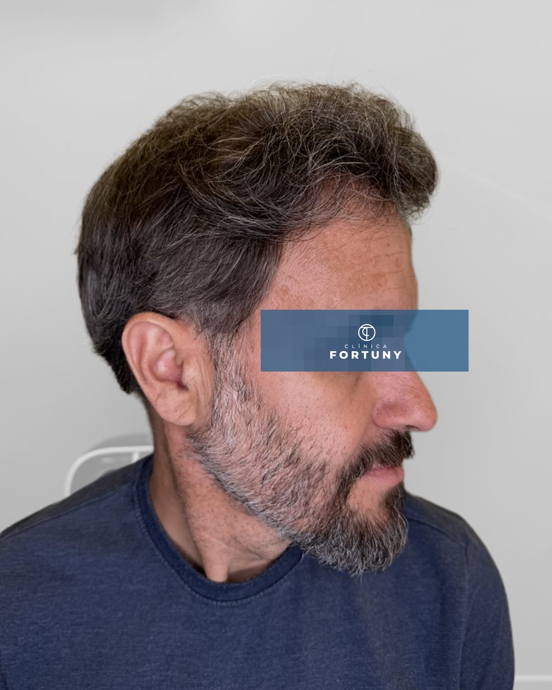 PACIENTE IMPLANTE CAPILAR ANTES Y DESPUES